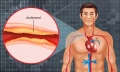 Cholesterol - hodnoty v tabulce podle věku